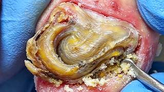 Super Large Onychomycosis, Successfully Cut Off The Fungus【Xue Yidao】