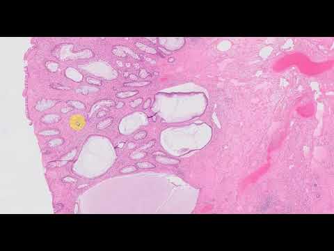 Sporadic juvenile polyp colon