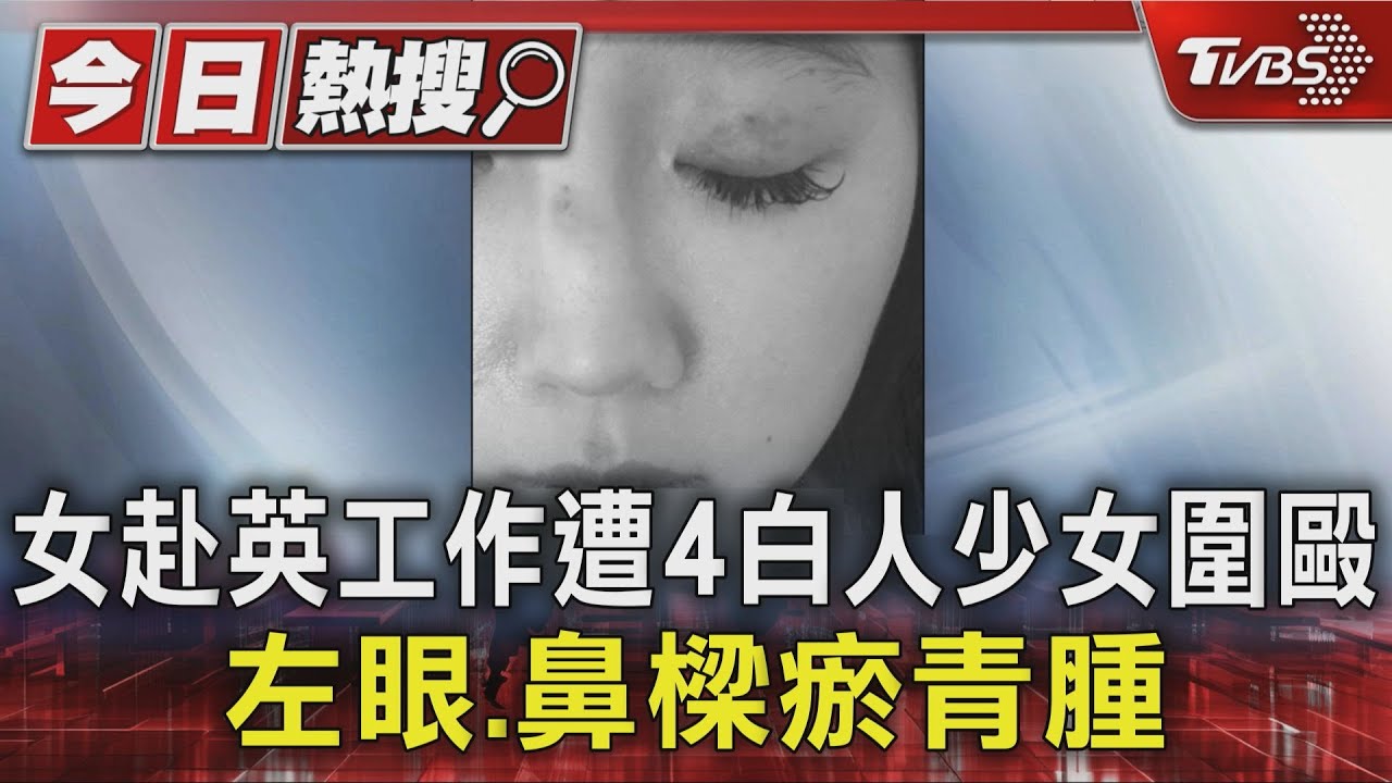 女赴英國工作突遭4白人少女圍毆 「左眼、鼻樑」瘀青紅腫