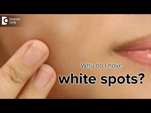 What is the cause of white spots on the skin? - Dr. Rasya Dixit