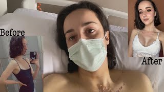 BREAST AUGMENTATION VLOG + RECOVERY | Marta Iglesias