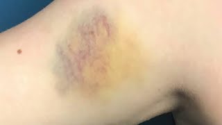 how to get rid of bruises on arms fast and easy