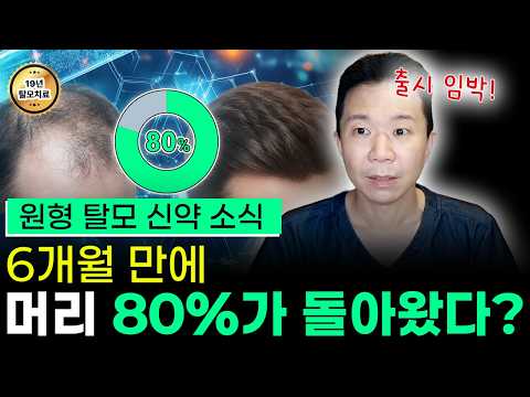 빠진 머리 80%가 돌아왔다…원형탈모 신약 효과 이 정도였습니다
