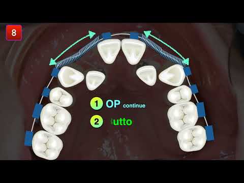 Pseudo class III with severe crowding｜【Chris Chang Ortho】CC635