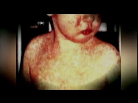 麻疹爆發促使紐約市郊區進入緊急狀態。 (Measles outbreak prompts state of emergency in NYC suburb)