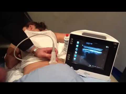 Ultrasound Guided SI Joint Injection - How To