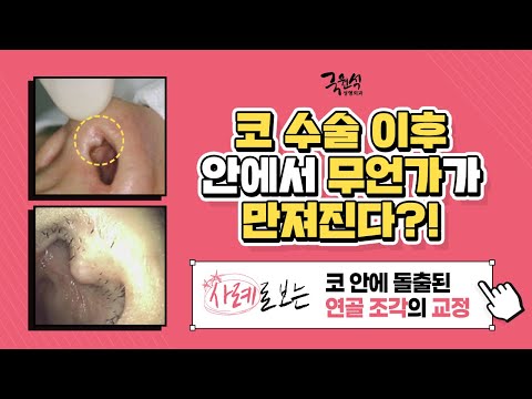 #코수술 이후 비주에 돌출된 것이 있을 때! [feat. 실제사례로 보는 연골 조각의 교정]