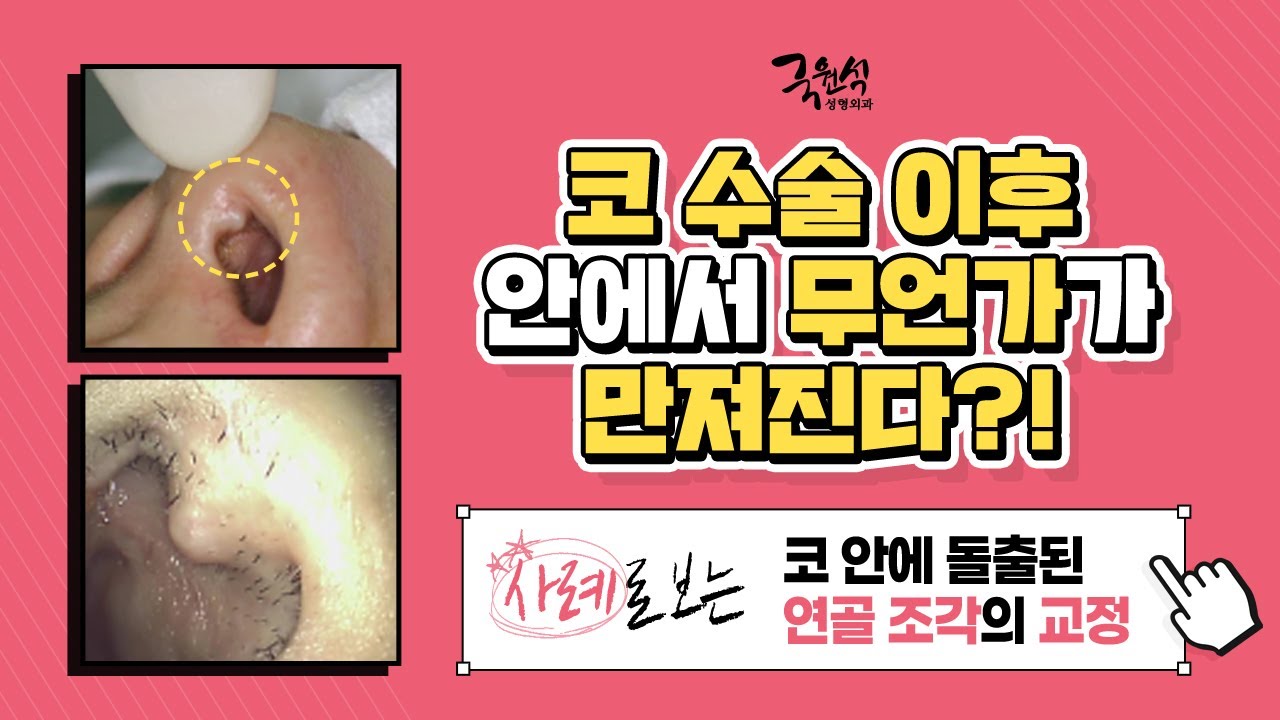 #코수술 이후 비주에 돌출된 것이 있을 때! [feat. 실제사례로 보는 연골 조각의 교정]