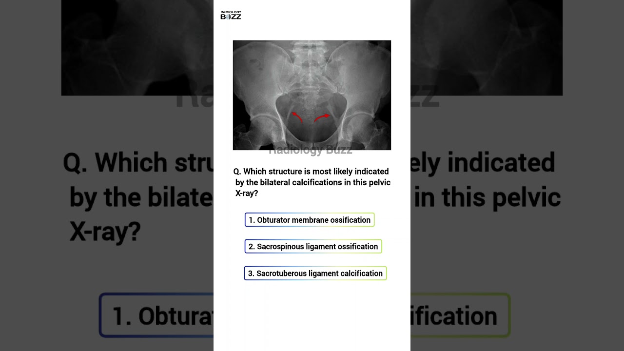 🩺Pelvic Anatomy Quiz: Identify the Finding!🤔 #radiologybuzz #anatomy