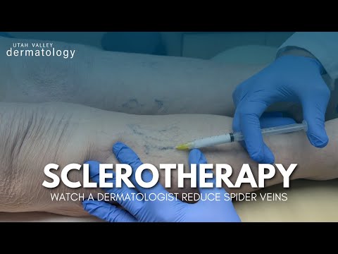 Watch These Spider Veins Disappear! Sclerotherapy | Utah Valley Dermatology
