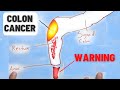4 Warning Signs Of Colon Cancer You Should NEVER Ignore