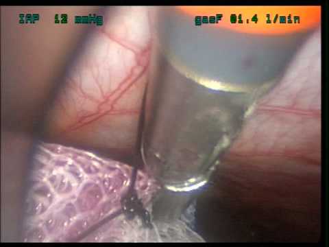 SILS Correction Of The Hernia