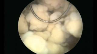 Λιθίαση κύστης 02