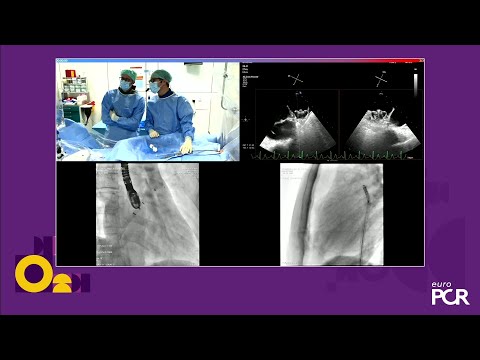 Broadening OPTIONs for LAA closure: innovations and outcomes - EuroPCR 2025