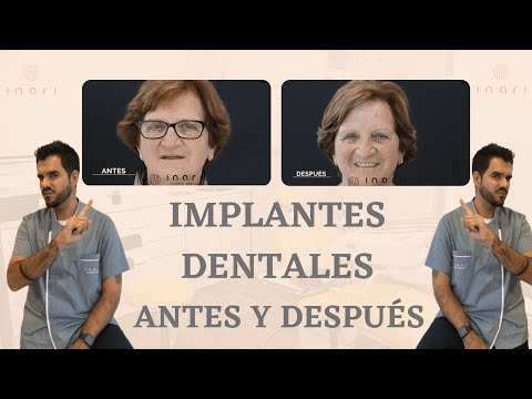 Implantes dentales Alcorcon