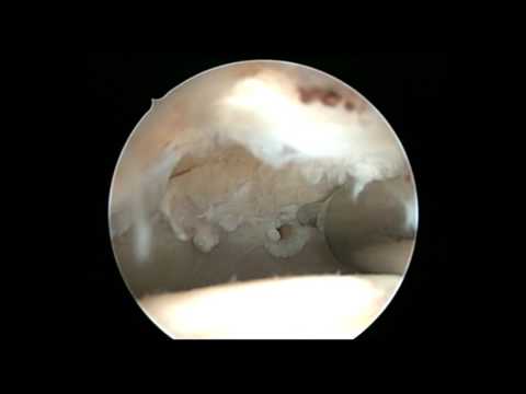 Ce este artroza articulațiilor șoldului de 1 grad