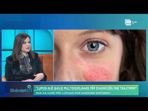 Trajtimi i lupusit, Dr.Ergeta Ktona: Është një sëmundje që e shoqëron pacientin gjithë jetës