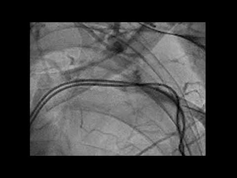 Venous Access in Subclavian Occlusion Micropuncture with Audio