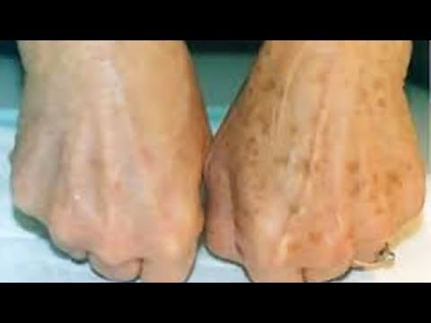 Бадяга форте гель для лица от пигментных пятен отзывы Удаление веснушек по всему телу