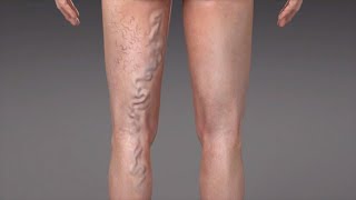 What are Varicose Veins?