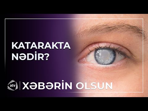 Katarakta xəstəliyi gəncləşib