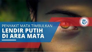 Pterigium, Penyakit Mata yang Menimbulkan Selaput atau Lendir Putih di Area Mata