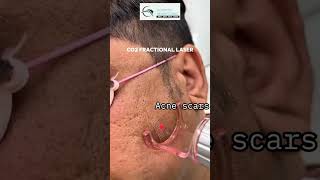 ✨ Say hello to flawless skin with **CO2 Fractional Laser**! ✨