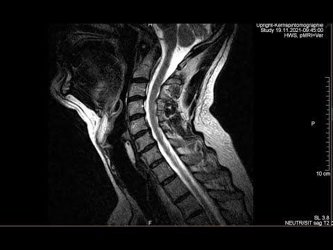 Meine Story - Instabilität obere HWS Atlas Axis - eine jahrelange Suche