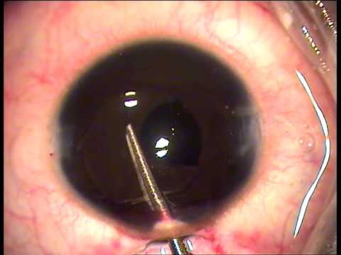 Retro iris fixated Intra-ocular lens (IOL) in children