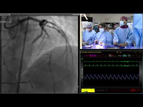 Live in Box Case: LAD CTO PCI-  April 2022