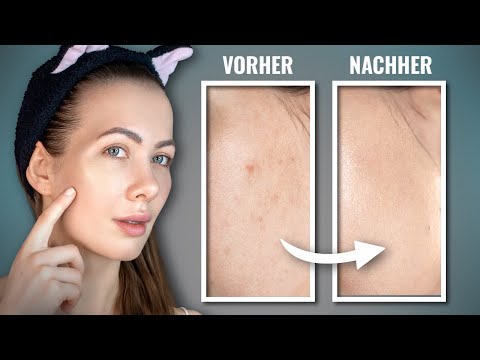 SCHNELL Pigmentflecken entfernen & rote Pickelmale loswerden - Bleib Fleckenfrei!