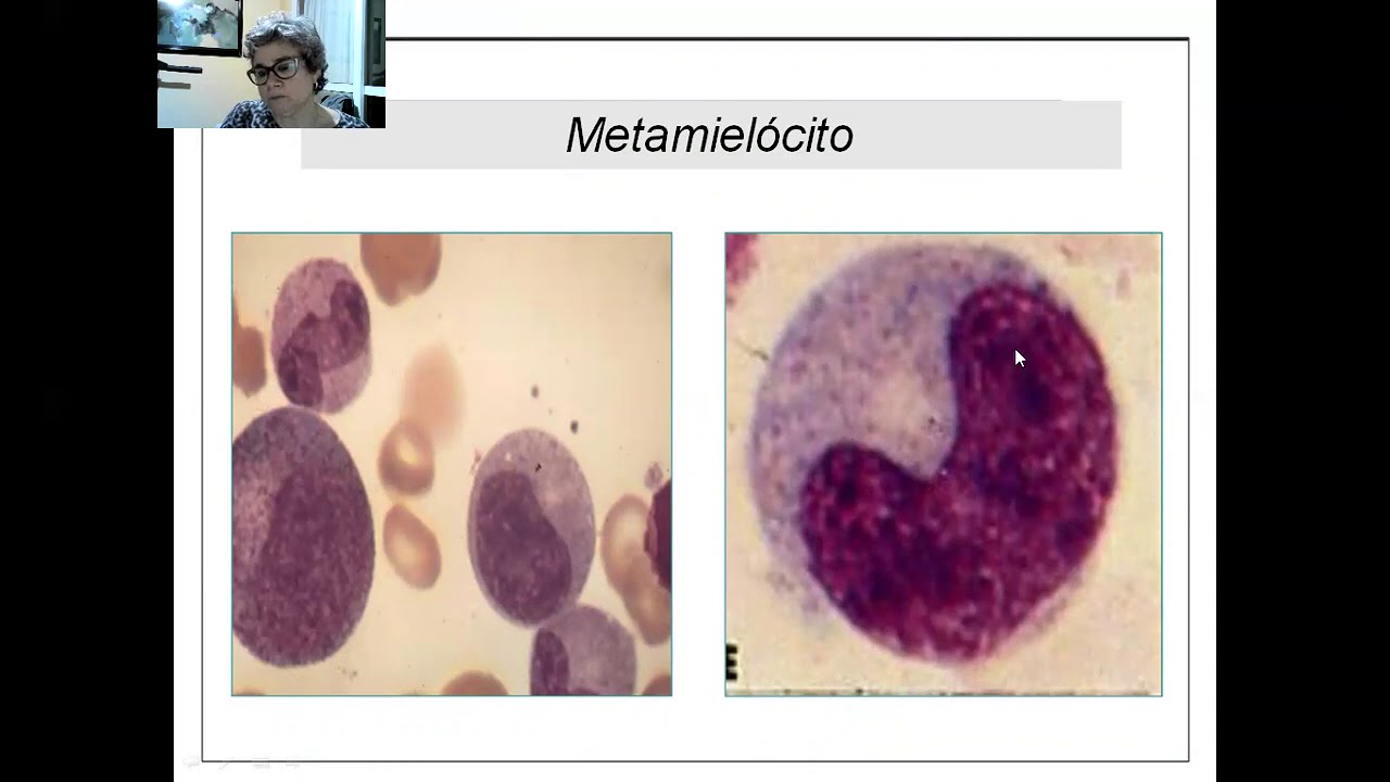 Granulócitos imaturos