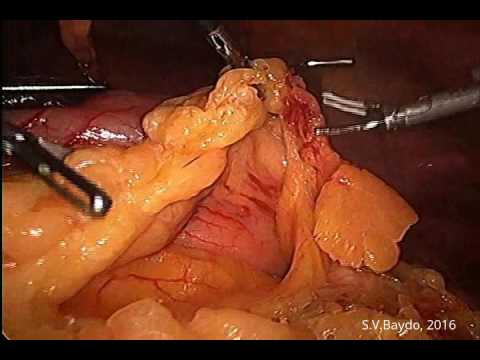 Laparoscopic D2-partial Gastrectomy 