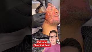 SHOCKING CHEMICAL PEEL - Phenol Peel Results #shorts