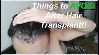 Things NOT to Do After Hair Transplant!