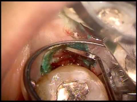 大きく切った歯茎の１カ月後 - EE DENTAL_Blog