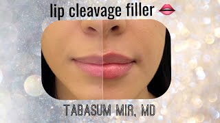How To create Lip Cleavage with filler