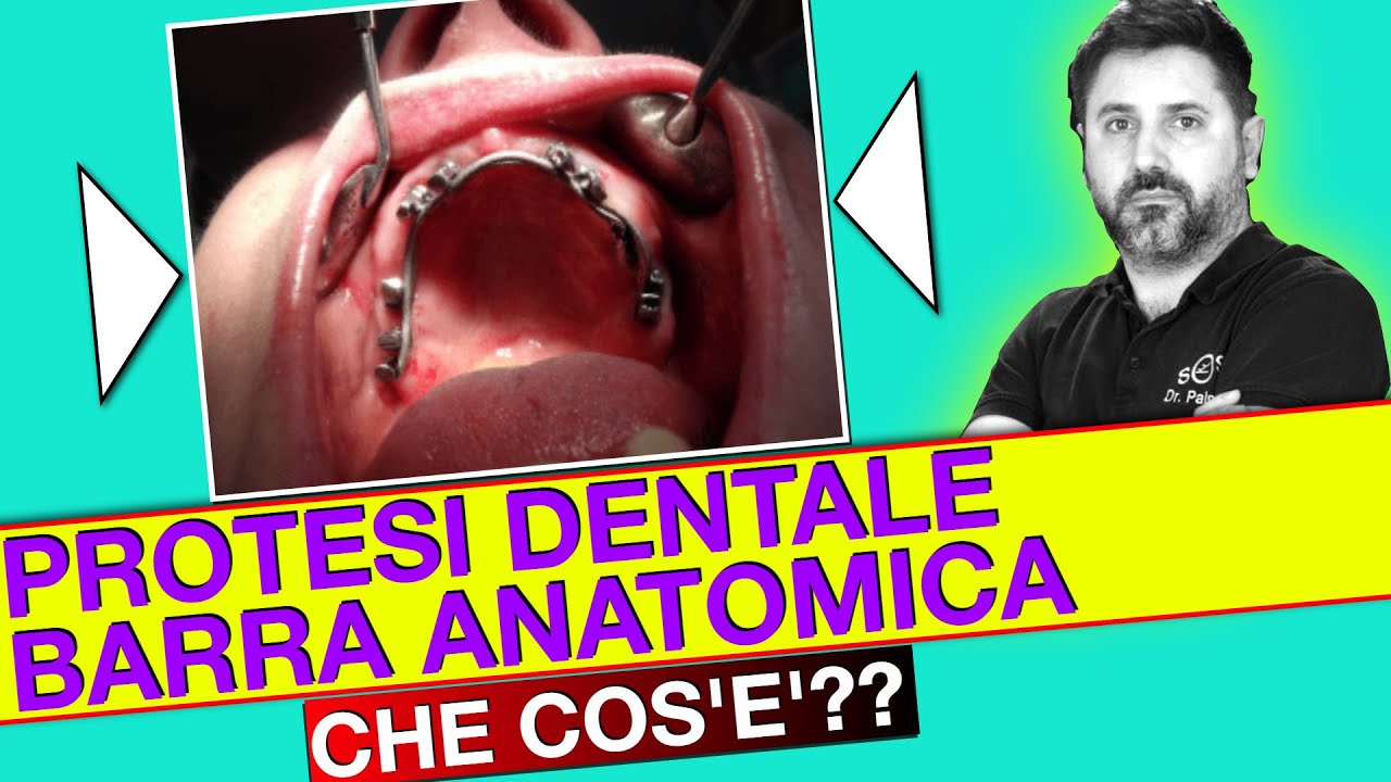 Watch Now Cos'è la Protesi Fissa su Impianti con Barra Anatomica Cos'è la Protesi Fissa su Impianti con Barra Anatomica