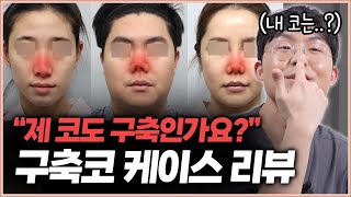 코 성형 후 쪼그라든 코... 이렇게 살렸습니다! (구축코 재수술 모아보기)