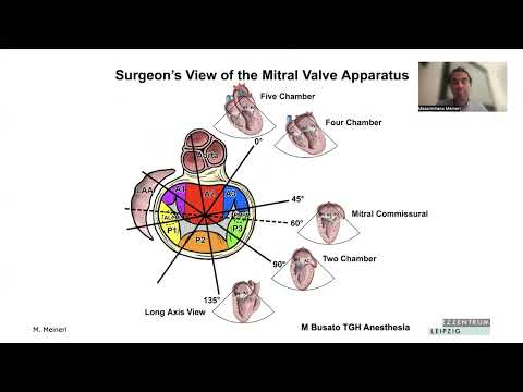 5. Echocardiographic Assessment of Minimally Invasive Mitral Valve Repair - Dr. Massimiliano Meineri