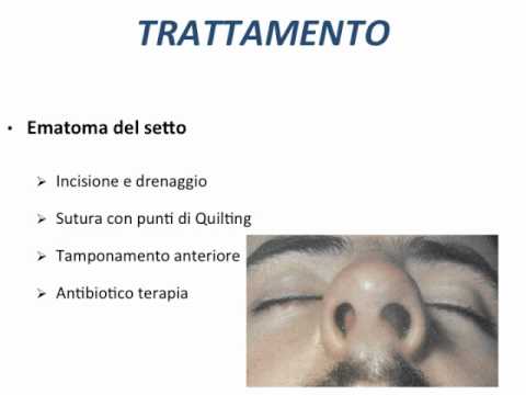 Candeggiare lentiggini gidroperity Sbatta una gomma da cancellare fino a rendere cremoso da posti di pigmentary