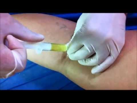 Guaritori malattia degenerativa del disco cervicale Sigillo e dolore al collo e del collo