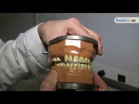 Il trattamento medico di artrosi del ginocchio Tar di betulla per il trattamento delle articolazioni