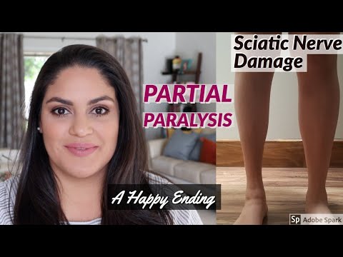 Nerve Damage and Partial Paralysis | Foot Drop in my 20s | My Happy Ending