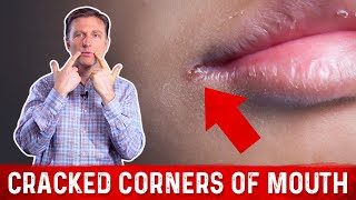What Causes Cracked Corners of Mouth & How to Get Rid of Angular Cheilitis? – Dr.Berg
