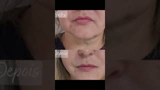 Download lagu Ruga da Marionete, o famoso sorriso triste, como resolve lo. mp3