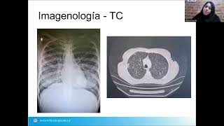 Tuberculosis-2