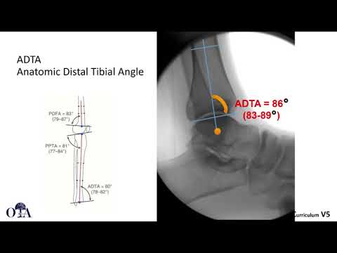 Tibial Pilon and Ankle Fractures – OrthoClips