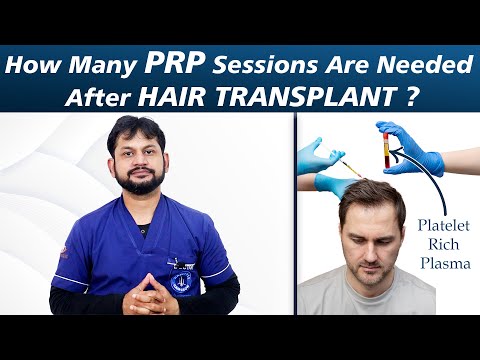How Many PRP Sessions Are Needed After Hair Transplant?