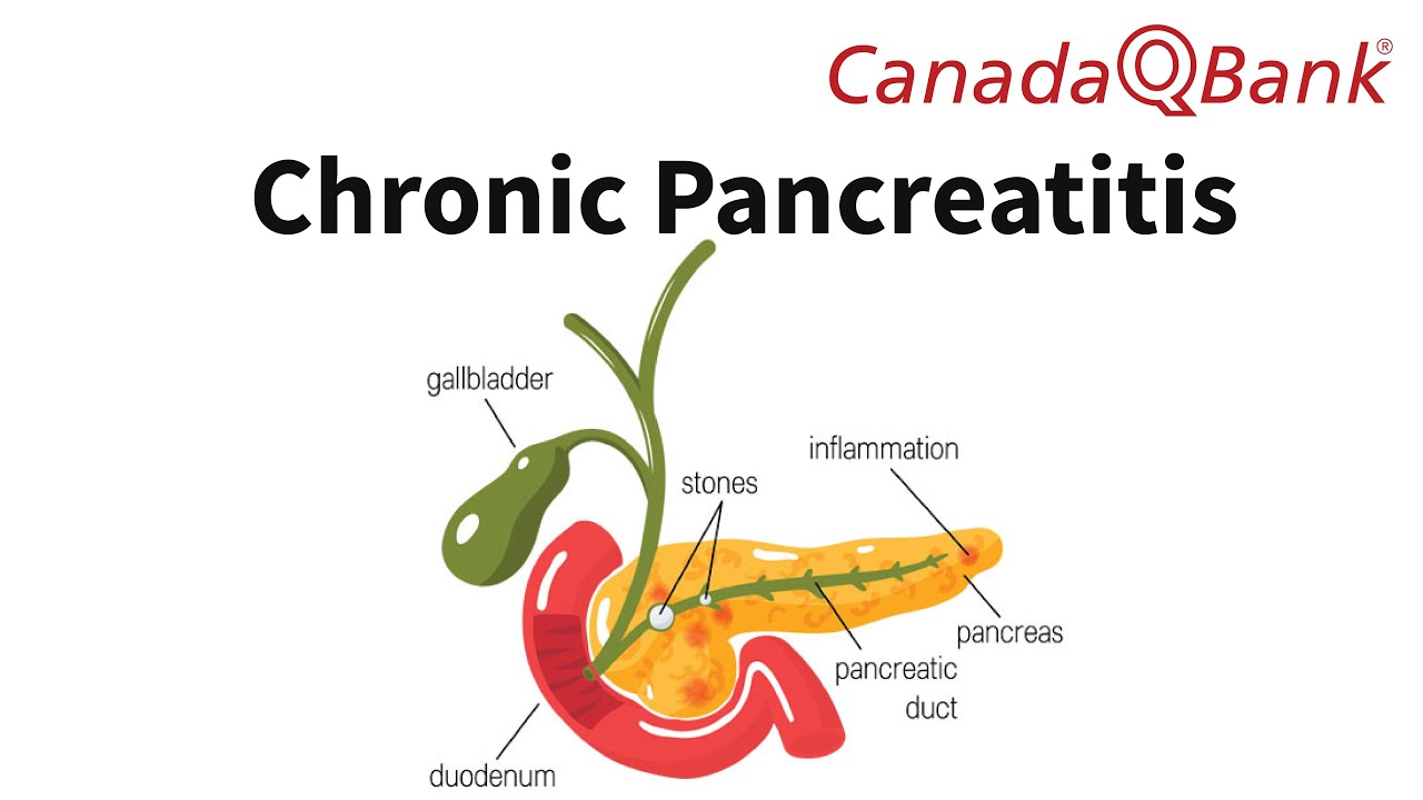 Chronic Pancreatitis Explained | Causes, Symptoms, Diagnosis & Management | CanadaQBank